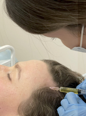 PRP-терапия волосистой части головы | Ultrasave